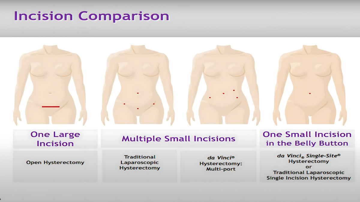 Gynecologic Robotic Surgery